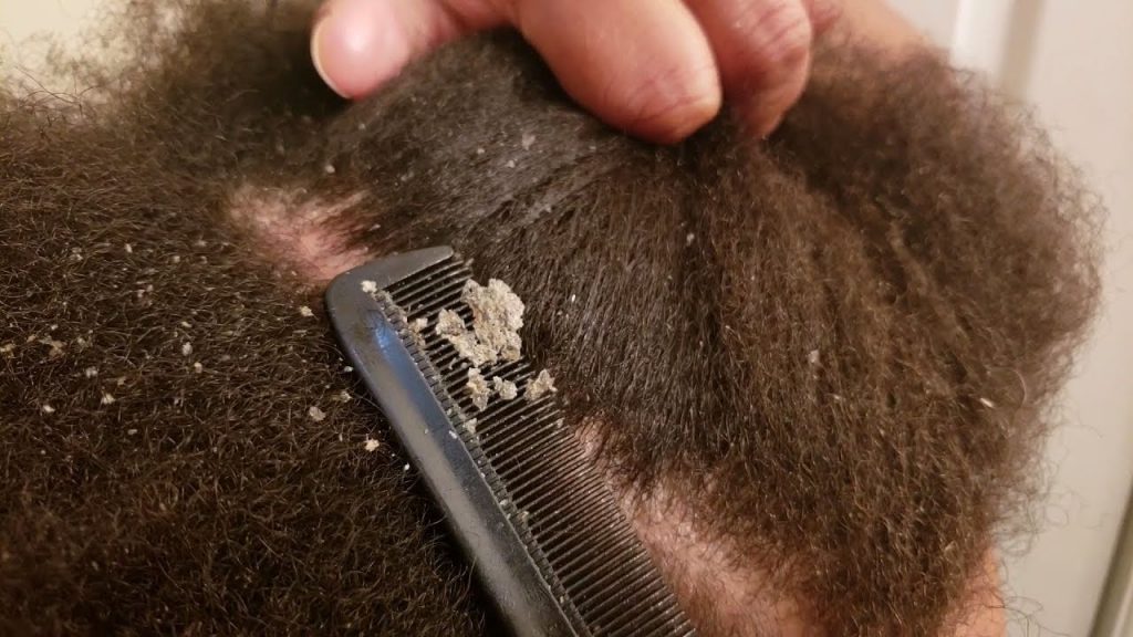 A close shot of dandruff on a man's sculp while combing hair