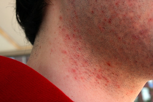 Closeup portrait of razor bumps on men's face