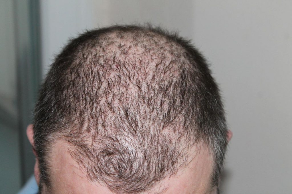 Closeup portrait of a man's bald head