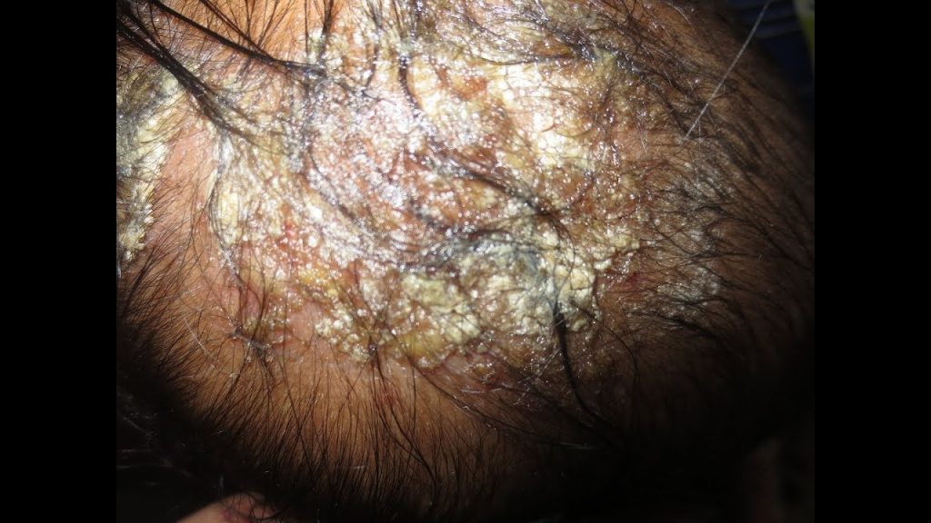 An image of the head skin of someone with seborrheic dermatitis