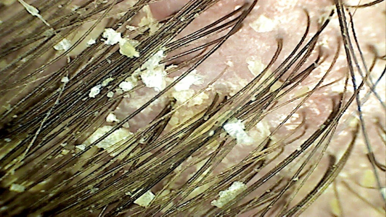 a photo of someone with seborrheic dermatitis's head skin
