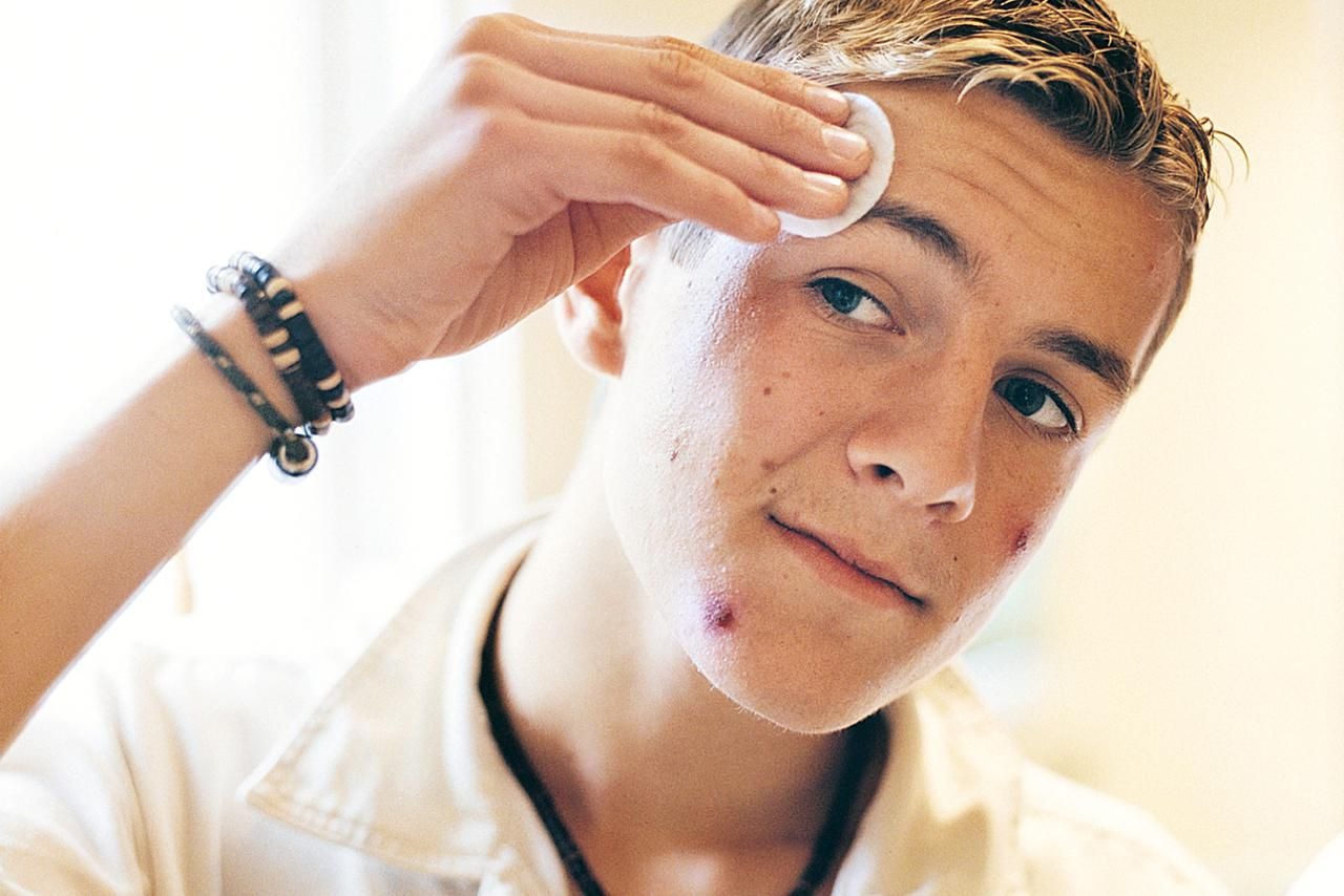 how to treat male teenage acne